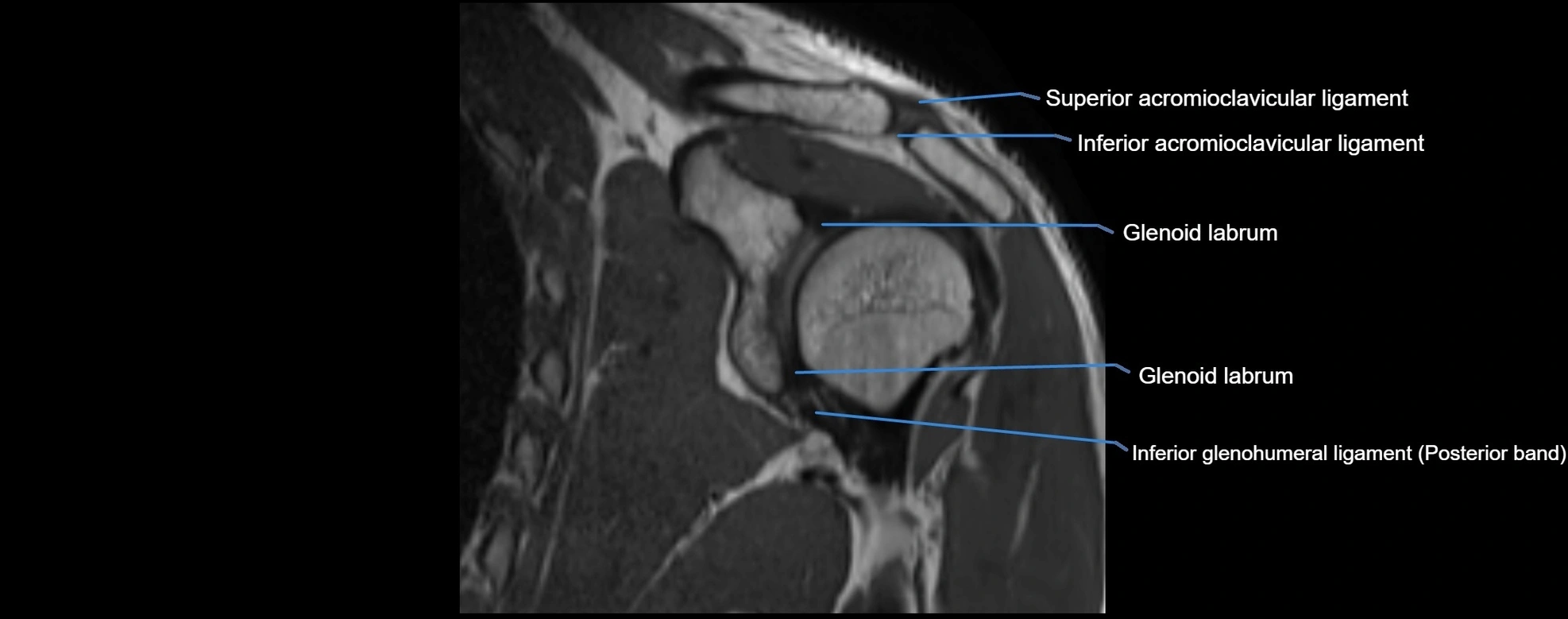 shoulder ligments coronal  cross sectional anatomy 3T MRI AI enhanced radiology image -img-00001-00027.webp